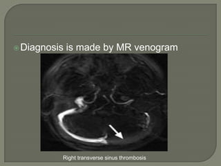 Diagnosis is made by MR venogram
Right transverse sinus thrombosis
 