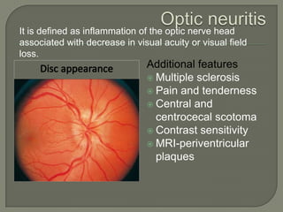 Additional features
 Multiple sclerosis
 Pain and tenderness
 Central and
centrocecal scotoma
 Contrast sensitivity
 MRI-periventricular
plaques
It is defined as inflammation of the optic nerve head
associated with decrease in visual acuity or visual field
loss.
 