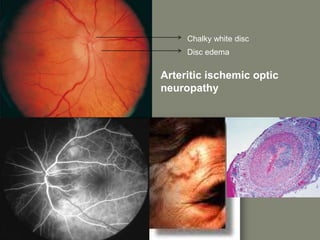 Chalky white disc
Disc edema
Arteritic ischemic optic
neuropathy
 