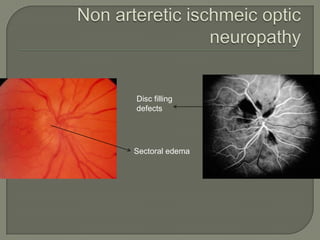 Sectoral edema
Disc filling
defects
 