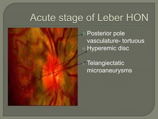  Posterior pole
vasculature- tortuous
 Hyperemic disc
 Telangiectatic
microaneurysms
 