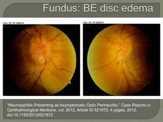 “Neurosyphilis Presenting as Asymptomatic Optic Perineuritis,” Case Reports in
Ophthalmological Medicine, vol. 2012, Article ID 621872, 4 pages, 2012.
doi:10.1155/2012/621872
 