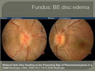 Bilateral Optic Disc Swelling as the Presenting Sign of Pheochromocytoma in a
Child Medscape J Med. 2008;10(7):176 © 2008 Medscape
 