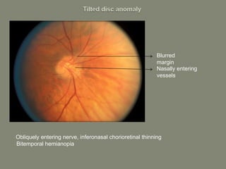 • Obliquely entering nerve, inferonasal chorioretinal thinning
• Bitemporal hemianopia
Blurred
margin
Nasally entering
vessels
 