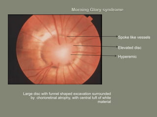Large disc with funnel shaped excavation surrounded
by chorioretinal atrophy, with central tuft of white
material
Spoke like vessels
Elevated disc
Hyperemic
 