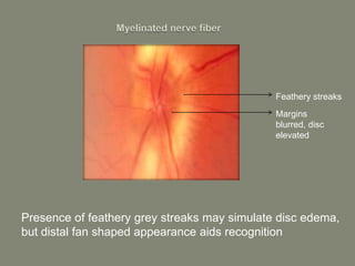 Presence of feathery grey streaks may simulate disc edema,
but distal fan shaped appearance aids recognition
Feathery streaks
Margins
blurred, disc
elevated
 