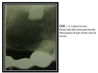 Interradicular Col DD of pericoronal RL.pptx