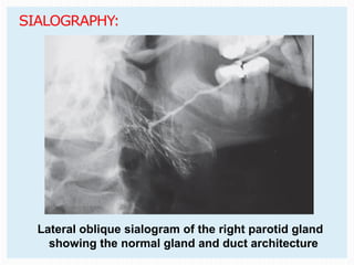 DD of salivary gland diseases me.pptx and the rest | PPTX