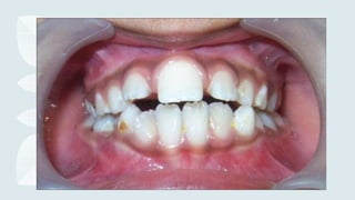 Frenulum Defect Developmental disturbances of teeth.pptx