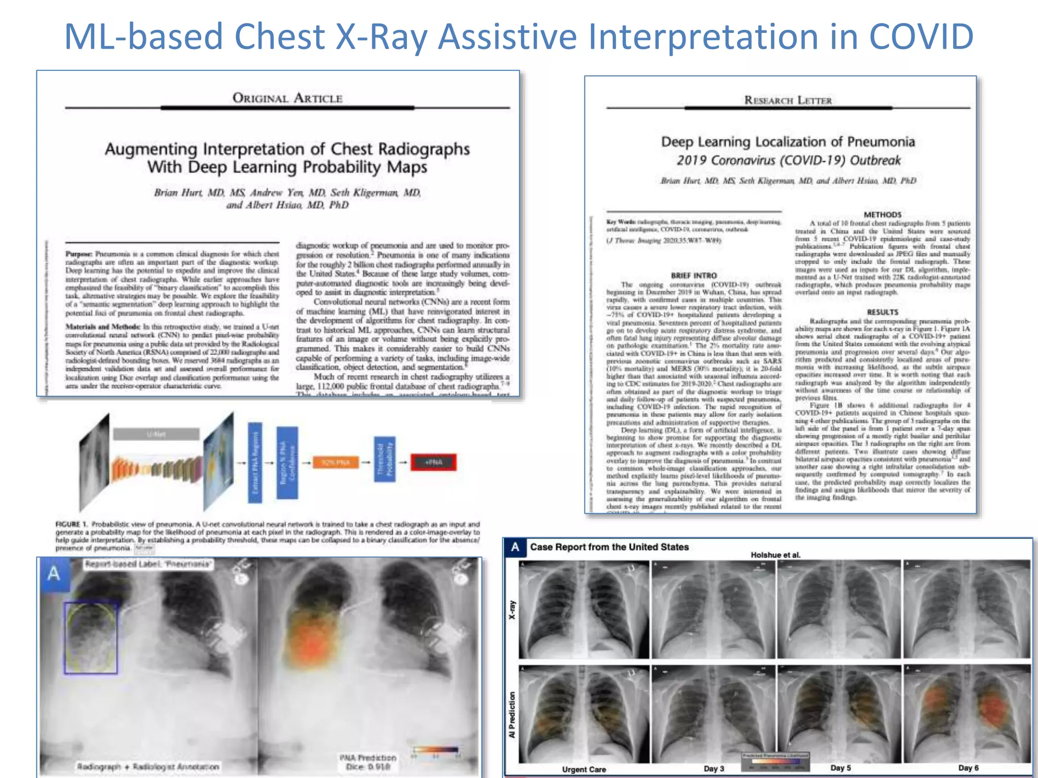 ML-based Chest X-Ray Assistive Interpretation in COVID
 