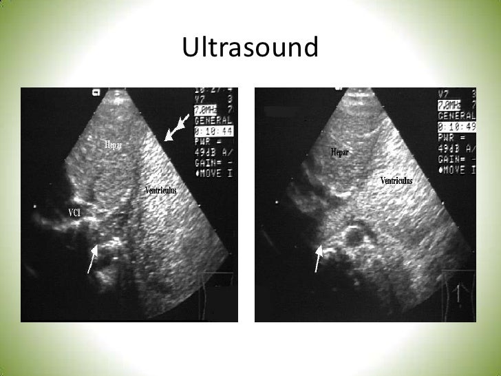 Dd wheezy chest in infant for fm