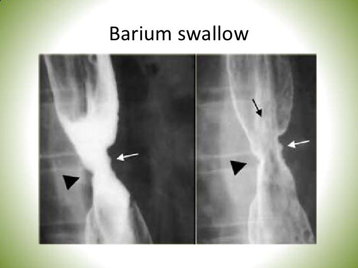 Dd wheezy chest in infant for fm