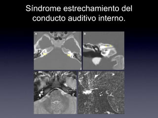 Síndrome estrechamiento del conducto auditivo interno.