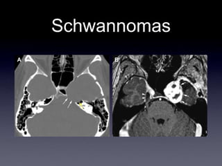 Schwannomas