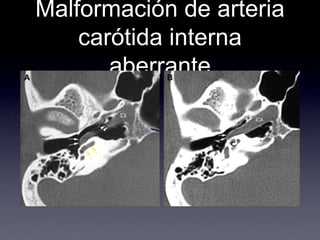 Malformación de arteria carótida interna aberrante