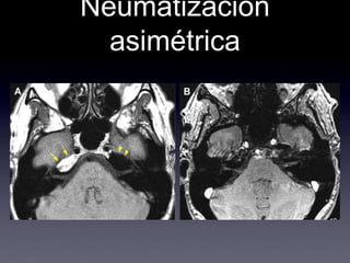 Neumatización asimétrica