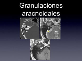 Granulaciones aracnoidales