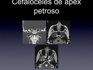 Cefaloceles de apex petroso