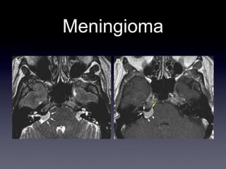 Meningioma