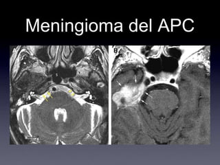Meningioma del APC