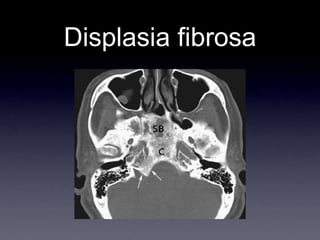 Displasia fibrosa