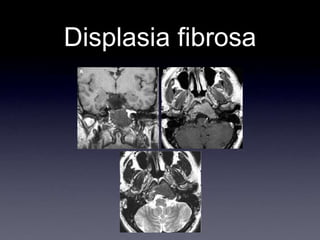 Displasia fibrosa