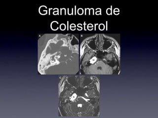 Granuloma de Colesterol