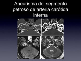 Aneurisma del segmento petroso de arteria carótida interna