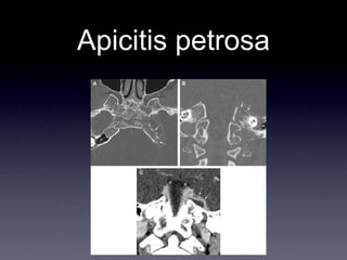 Apicitis petrosa
