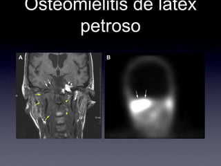 Osteomielitis de látex petroso