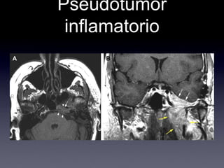 Pseudotumor inflamatorio