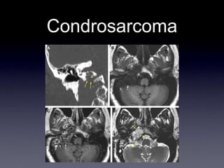 Condrosarcoma