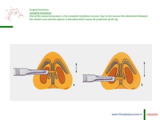 Transfixation Incision De-projection of the nasal tip | PPTX