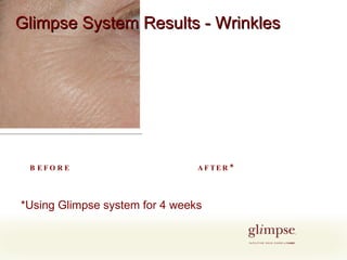 *Using Glimpse system for 4 weeks AFTER* BEFORE Glimpse System Results - Wrinkles 