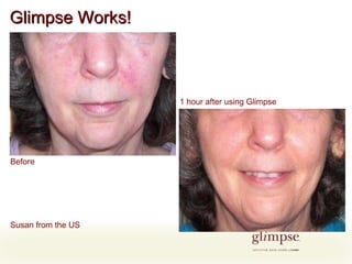 Glimpse Works! Before 1 hour after using Glimpse Susan from the US 