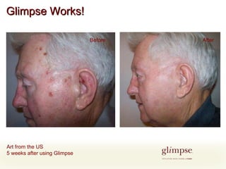 Glimpse Works! Art from the US 5 weeks after using Glimpse Before After 