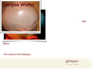 Before After Rui Ludovino from Malaysia Glimpse Works! 