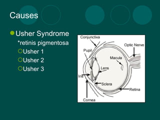 Causes Usher Syndrome *retinis pigmentosa  Usher 1 Usher 2 Usher 3 