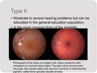 Type II
 Moderate to severe hearing problems but can be
educated in the general education population.
 Is the most common form of the disability
Photograph of the retina of a patient with Usher syndrome (left)
compared to a normal retina (right). The optic nerve (arrow) looks
very pale, the vessels (stars) are very thin and there is characteristic
pigment, called bone spicules (double arrows).
 
