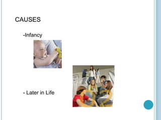 CAUSES
-Infancy
- Later in Life
 