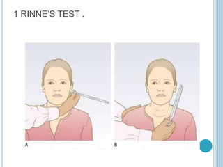 1 RINNE’S TEST .
 