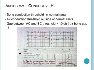 AUDIOGRAM – CONDUCTIVE HL
- Bone conduction threshold in normal rang .
- Air conduction threshold outside of normal limits.
- Gap between AC and BC threshold > 10 db ( air bone gap
).
 
