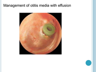 Management of otitis media with effusion
 