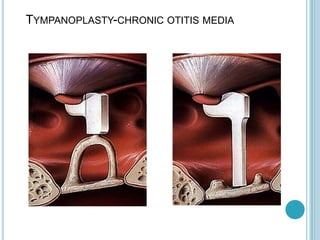 TYMPANOPLASTY-CHRONIC OTITIS MEDIA
 
