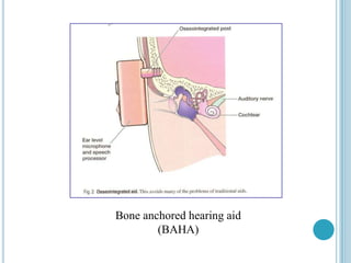 Bone anchored hearing aid
(BAHA)
 