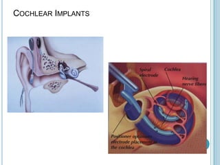 COCHLEAR IMPLANTS
 