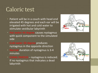 Normal Caloric Test ASSESSMENT OF Deafness | PPTX