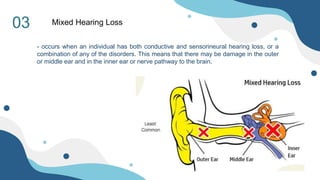03 Mixed Hearing Loss
- occurs when an individual has both conductive and sensorineural hearing loss, or a
combination of any of the disorders. This means that there may be damage in the outer
or middle ear and in the inner ear or nerve pathway to the brain.
 