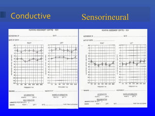 Conductive Sensorineural
 