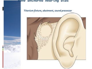 Bone anchored hearing aids
Titanium fixture, abutment, sound processor
 